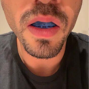 Mandibular Advancement Device image